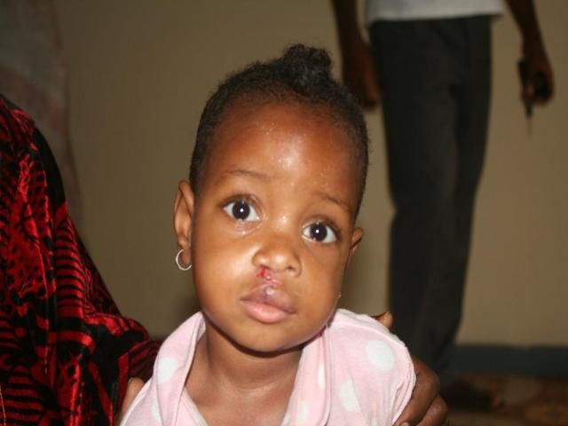 Kamerun-2013-Cleft