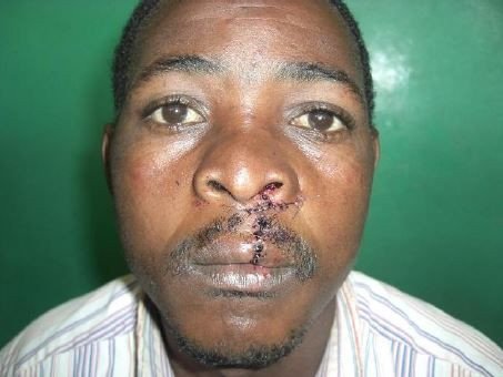 Ruanda-2013-Cleft