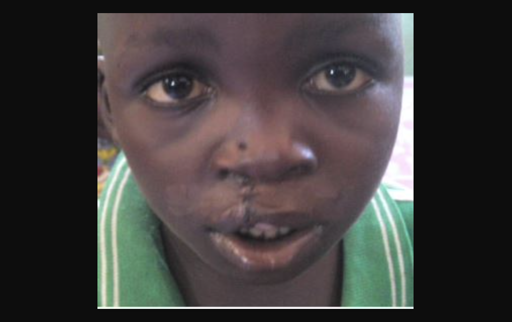 Ruanda-2014-Deutsche-Cleft-Kinderhilfe e.V.
