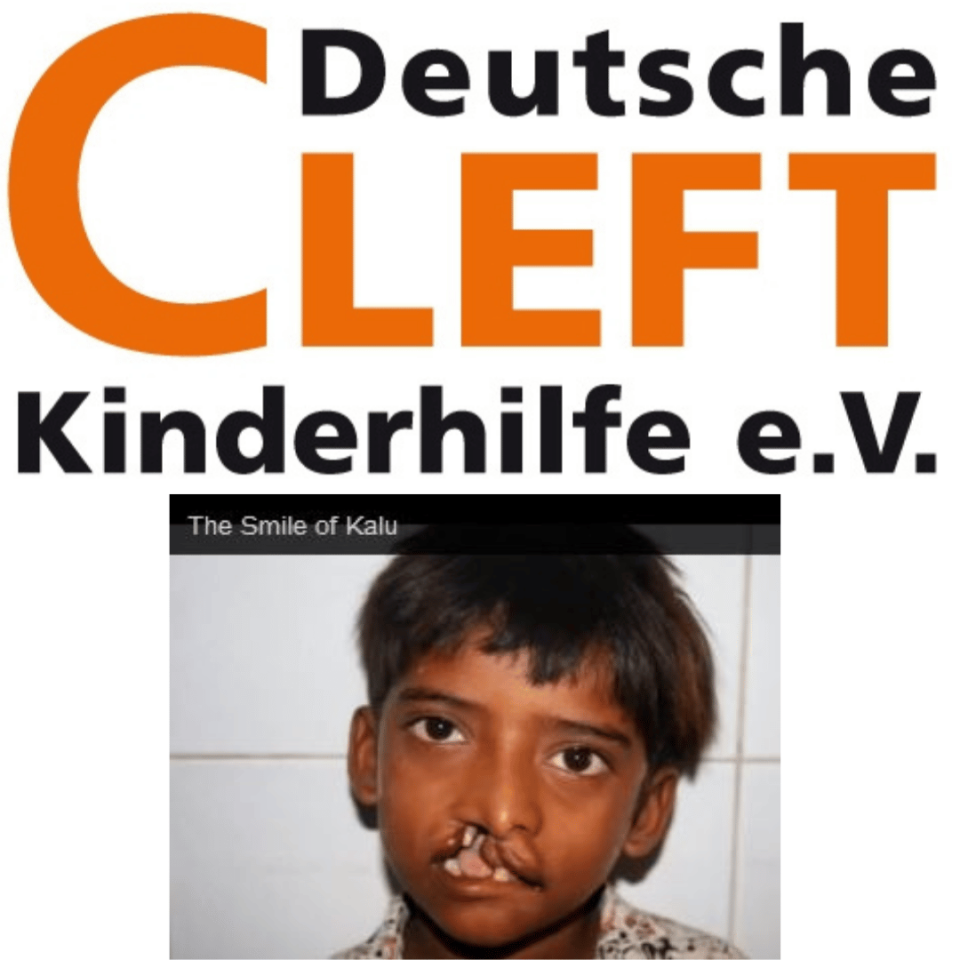 Cleft-Kalu-2013